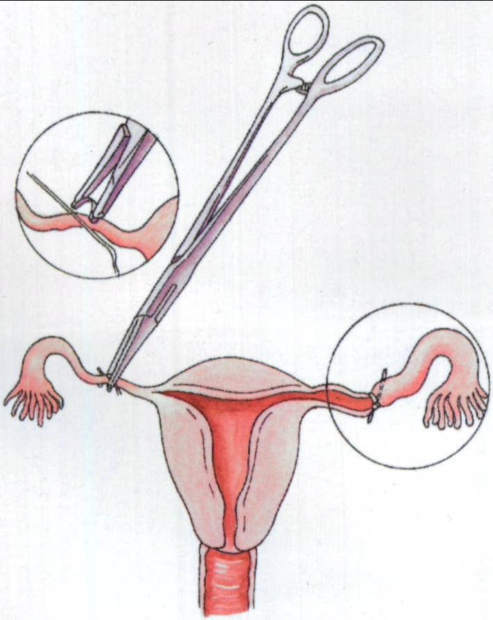 二、输卵管夹绝育术